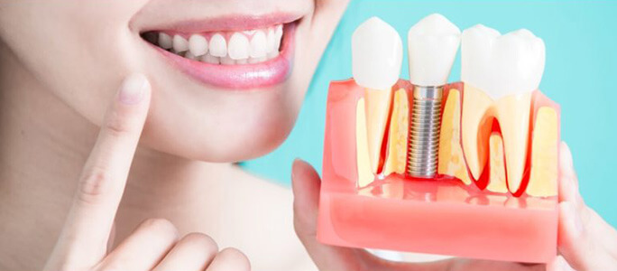 Dental Implant