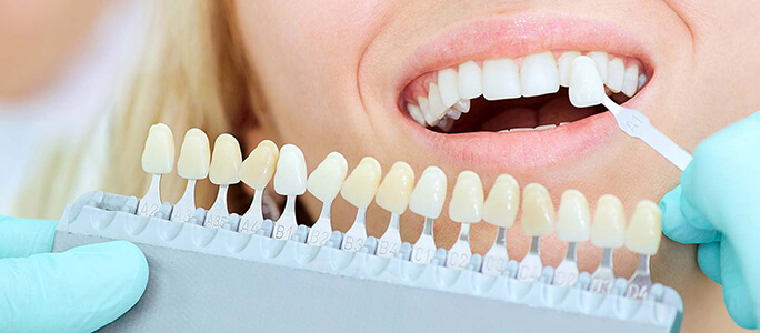 Dental Veneers